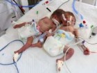تولد دوقلوهای به هم چسبیده در یکی از بیمارستان های قم
