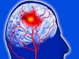 آشنایی با فاکتورهای پرخطر احتمال خونریزی در بازماندگان سکته مغزی